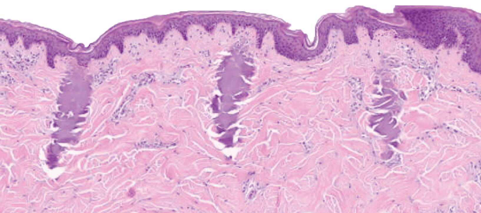 Folix coagulative zones